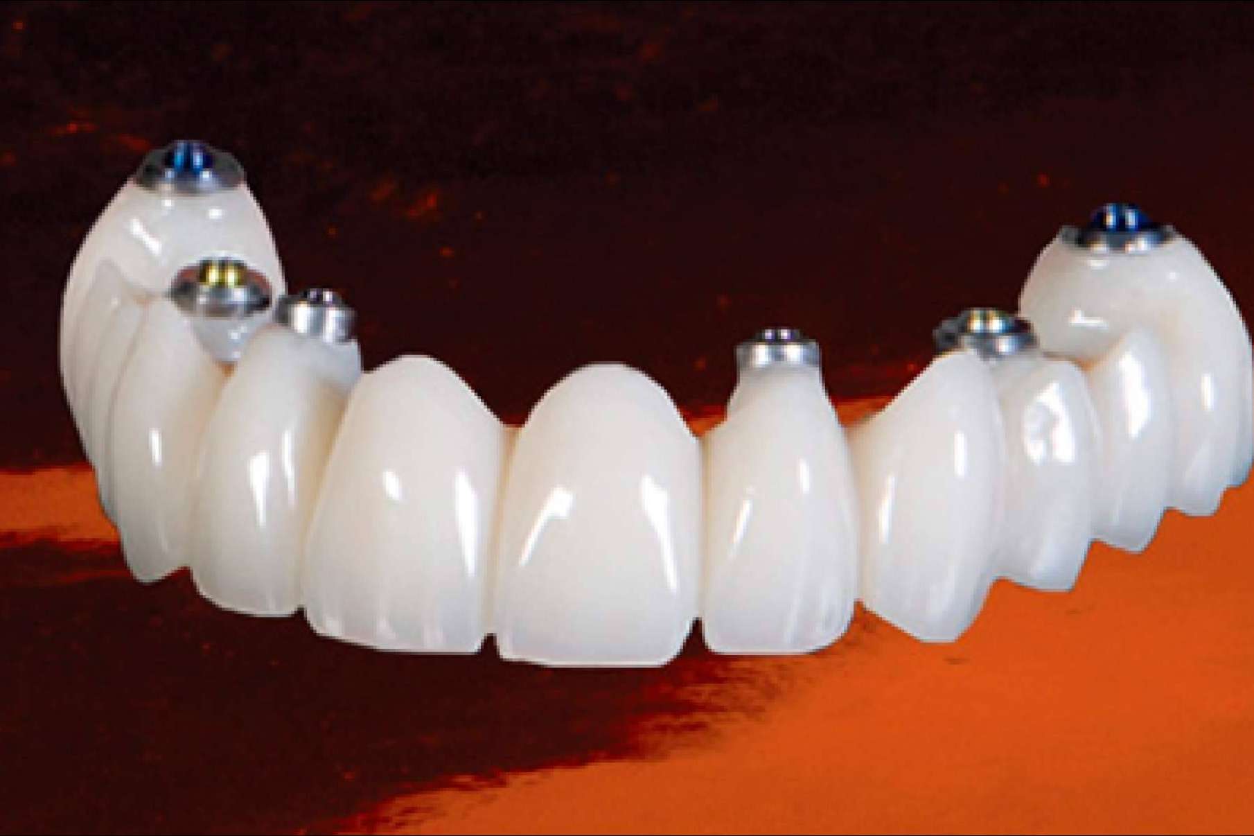 Dental Implantologie ofrece laboratorio propio para el servicio de estética dental y ortodoncia invisible
