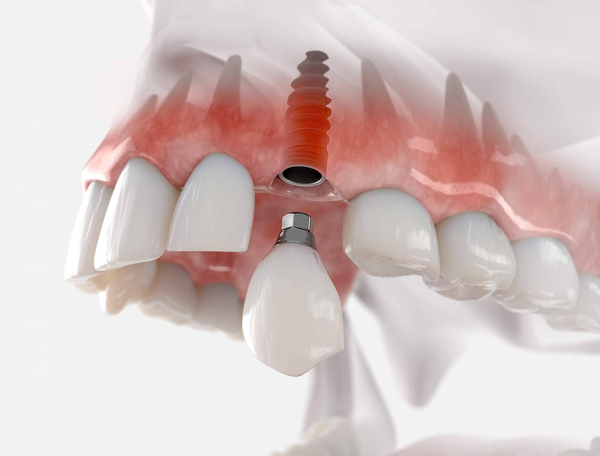 Implantes postextracción con carga inmediata, la técnica por la que apuesta Clínica Dental Sonrisas para conseguir una dentadura de 10 en sus pacientes