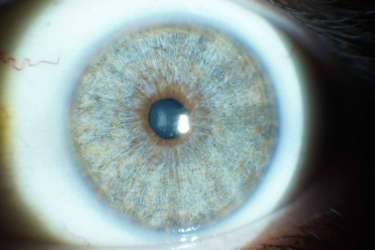 Los avances en las operaciones de cambio de color de ojos con láser, con Clínica Eyecos
